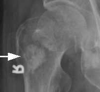 Osteoplastische Metastase